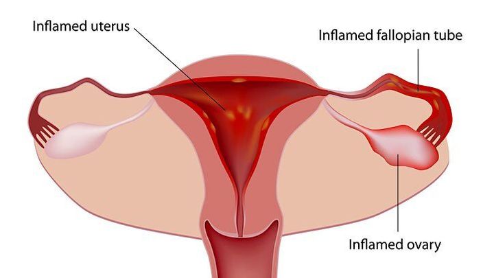 The Battle of the Uterus: A Humorous Take on Cramps 1